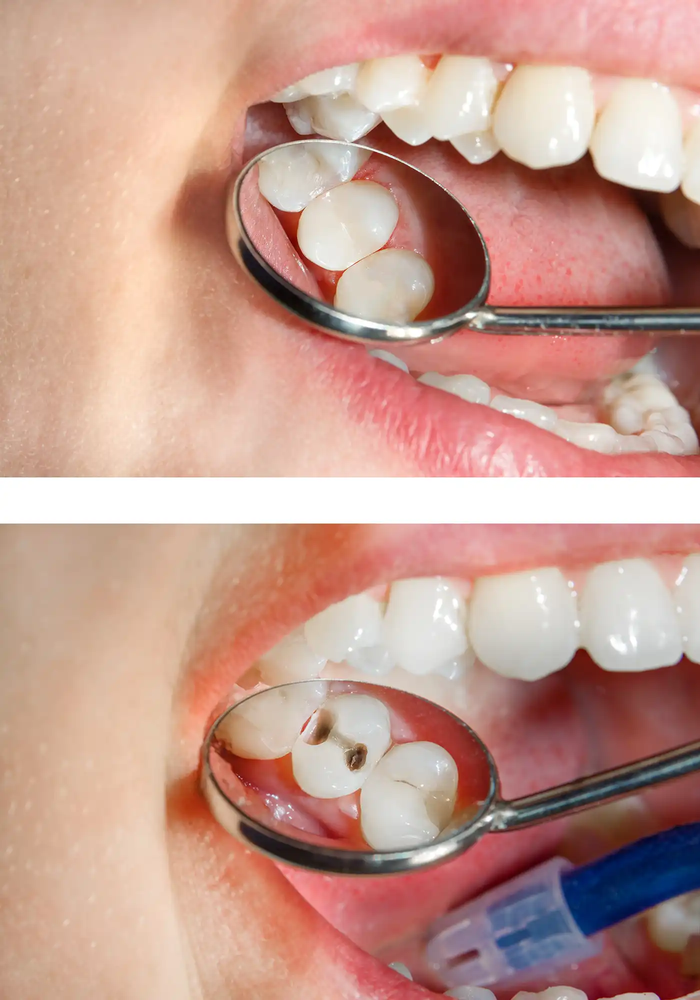 Tooth Coloured White Fillings