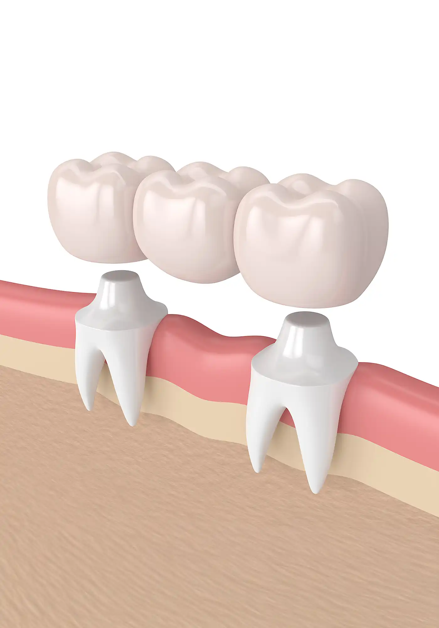 Dental Bridge
