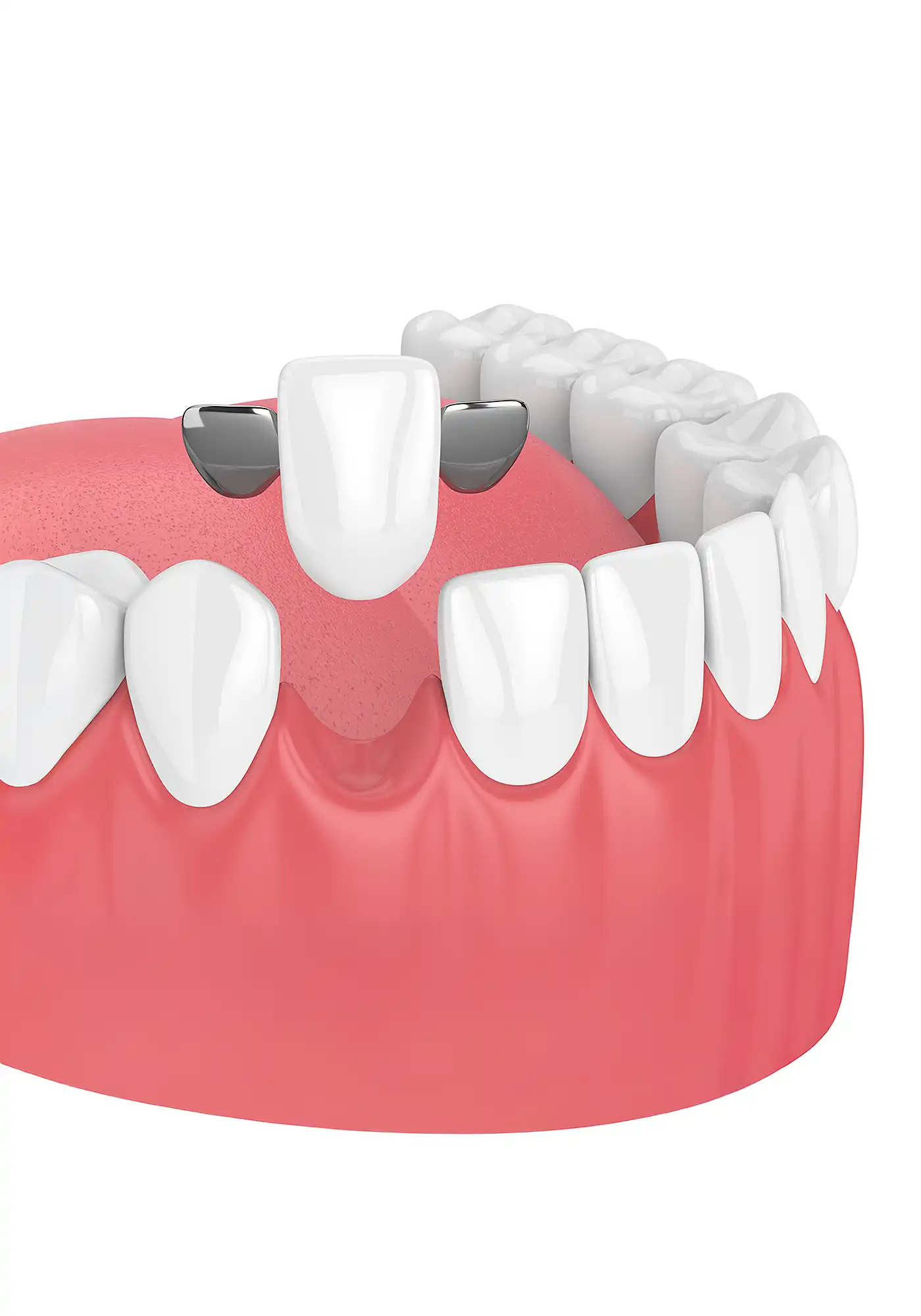 Adhesive Dental Bridge