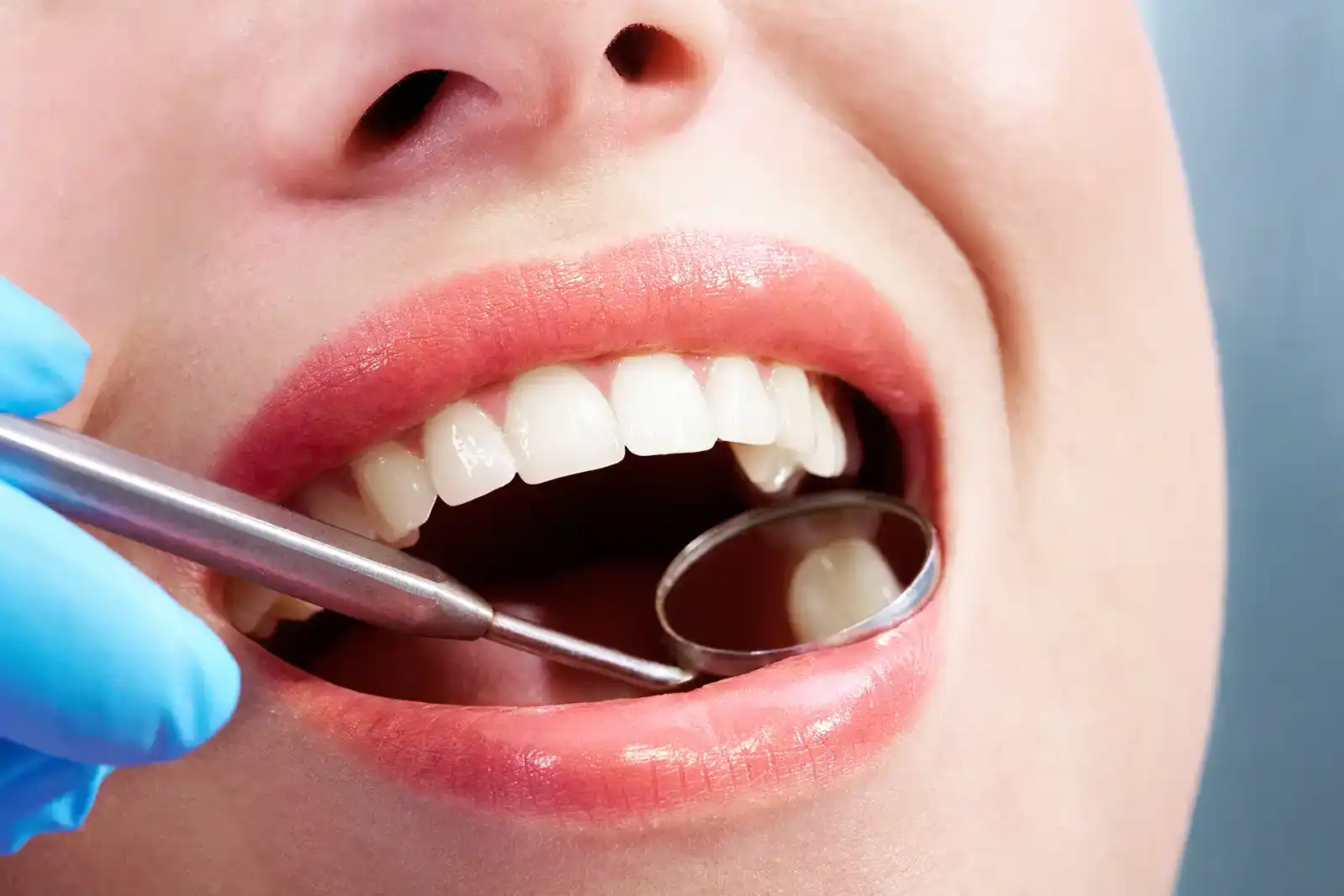 White Fillings