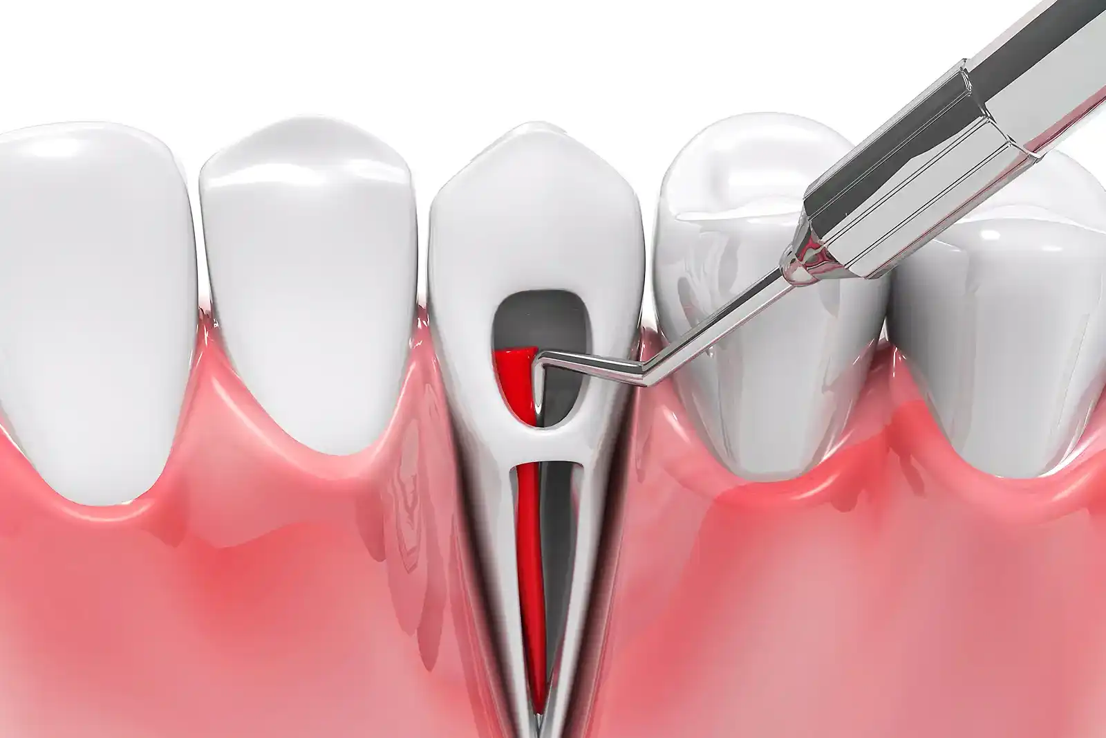 Root Canal Treatment