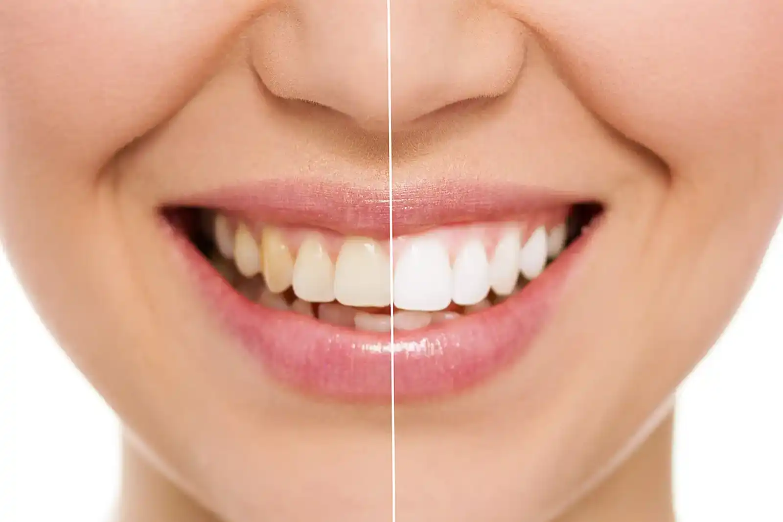 Teeth Whitening